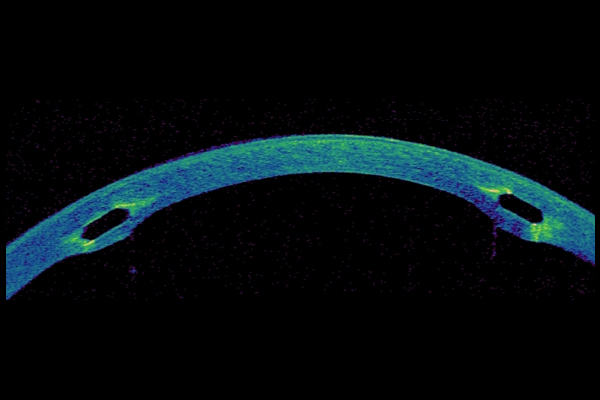 Intra corneal ring segments